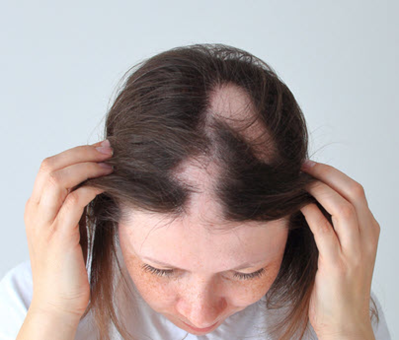 Amfibisch Kroniek aanplakbiljet Alopecia Areata - Slingeland Ziekenhuis