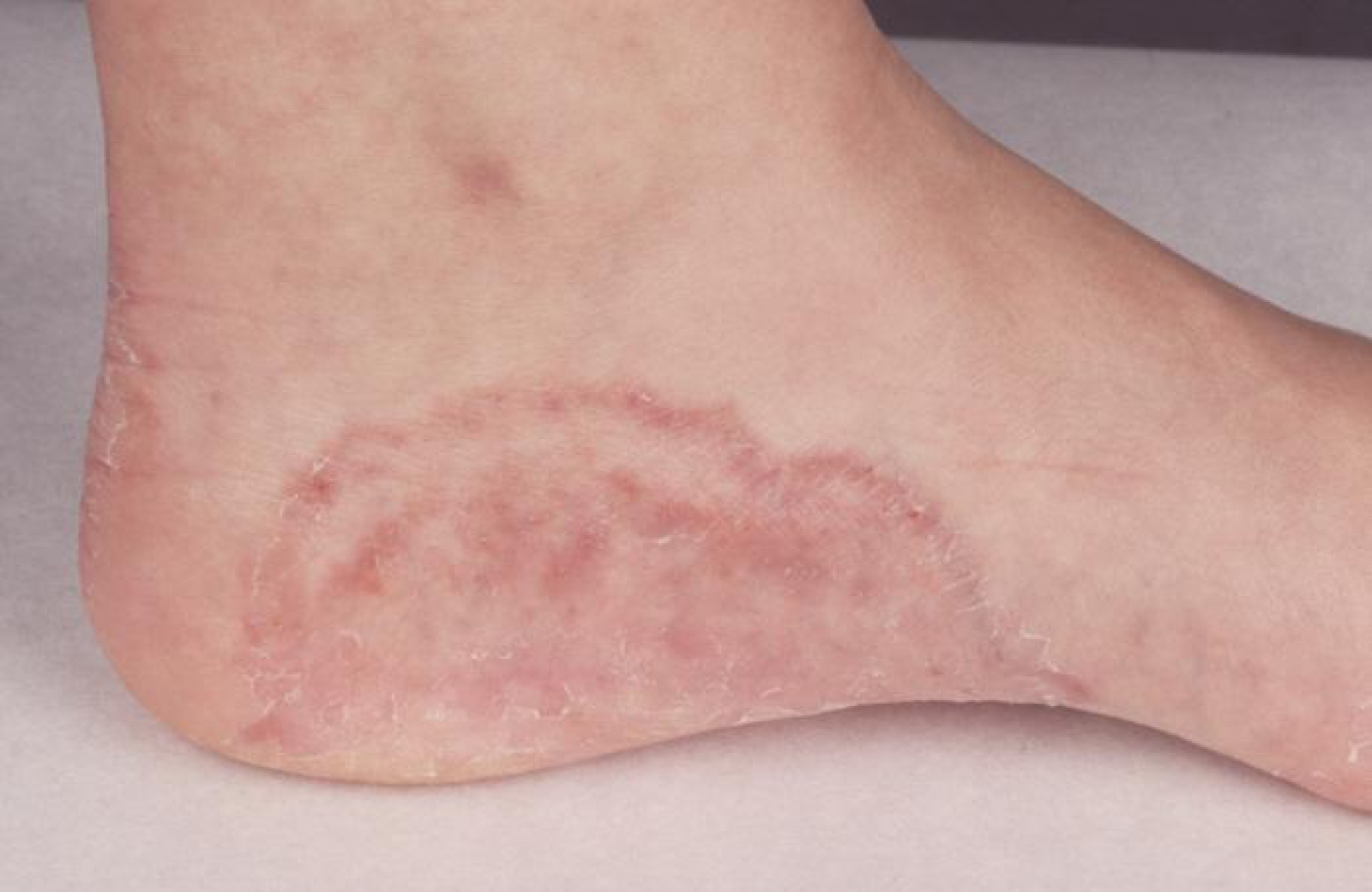 Schimmelinfecties van huid, nagel of - Slingeland