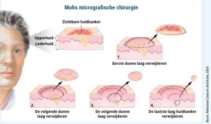 Mohs micrografische chirurgie